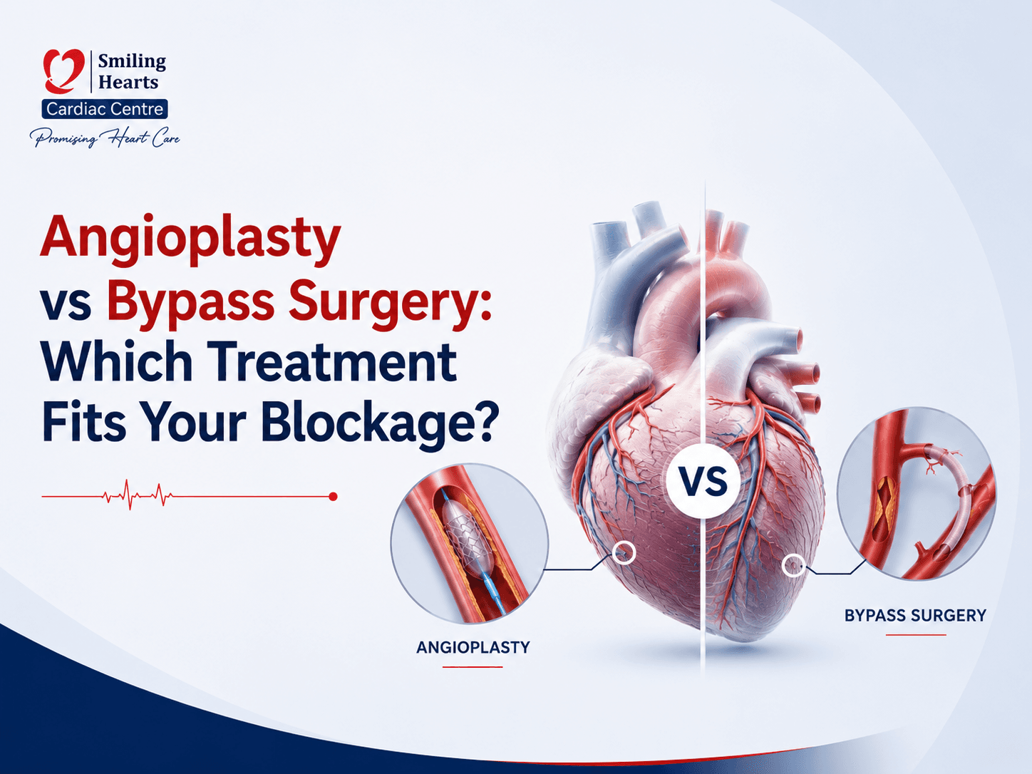 Angioplasty vs Bypass Surgery: How Cardiologists Decide